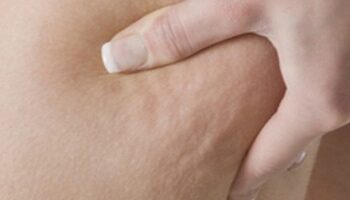 Κυτταρίτιδα:Ο εφιάλτης των γυναικών